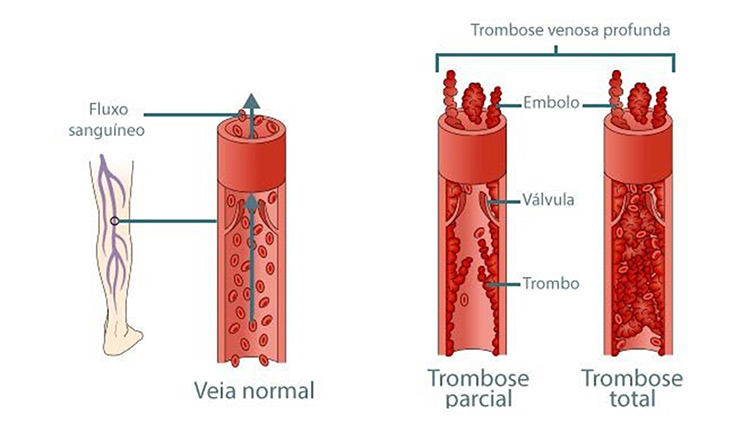 Ilustração: trombose